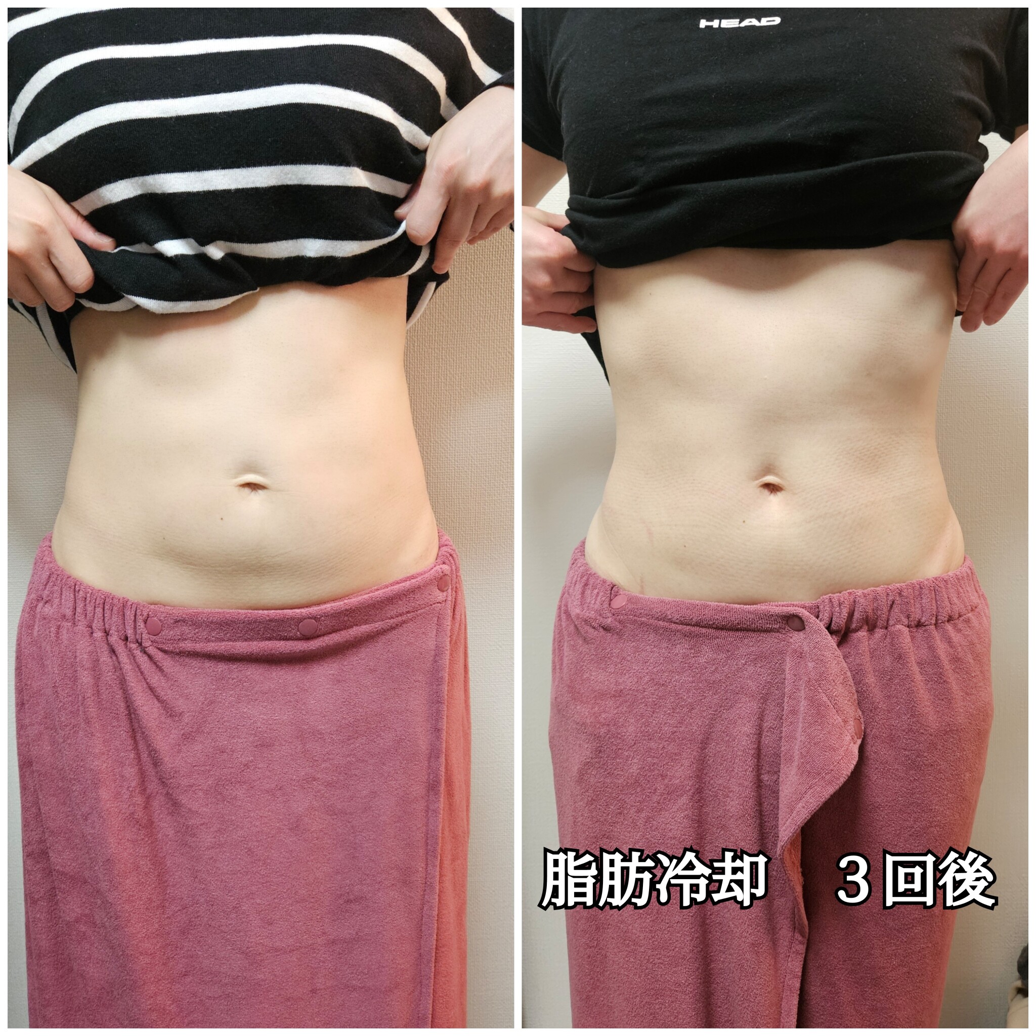 脂肪冷却 Before/After